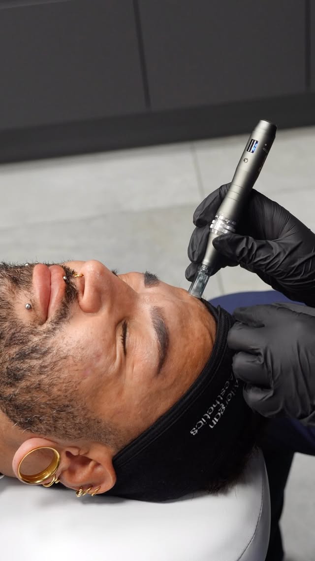Vorschau: Microneedling: Einblick in die Behandlung