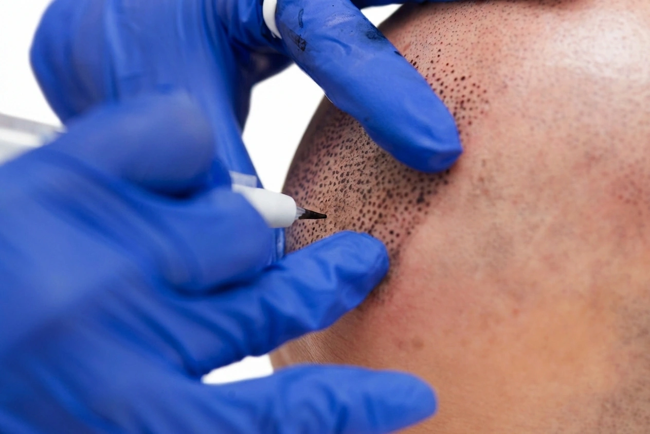 DHI Haartransplantation bei ID ESTHETIC Mannheim