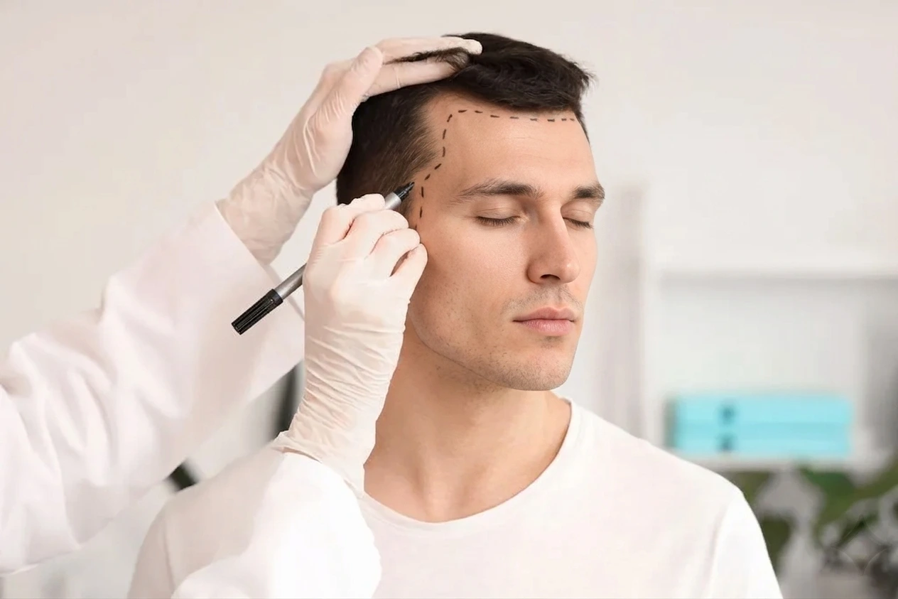 Ärztliche Markierung der Haarlinie vor einer Haartransplantation in Mannheim