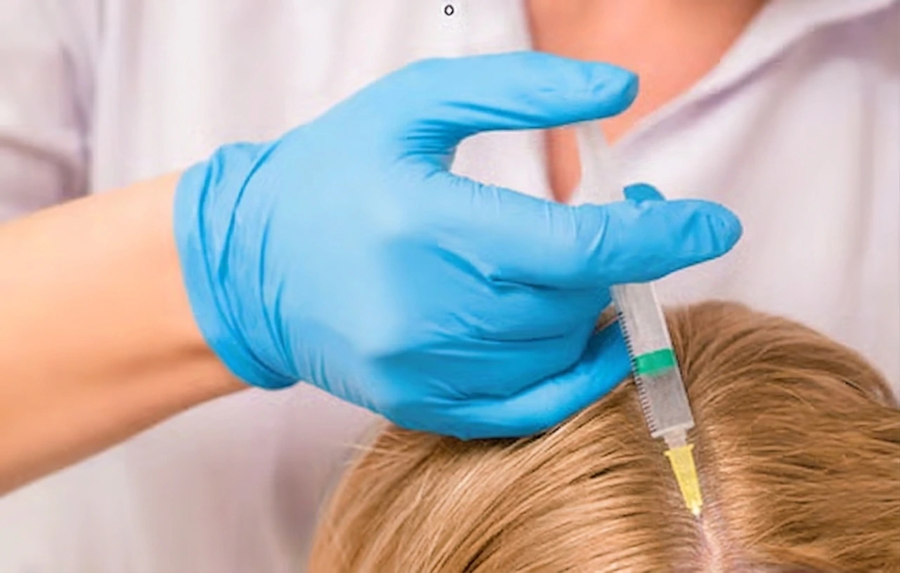Mesotherapie-Behandlung der Kopfhaut in Mannheim